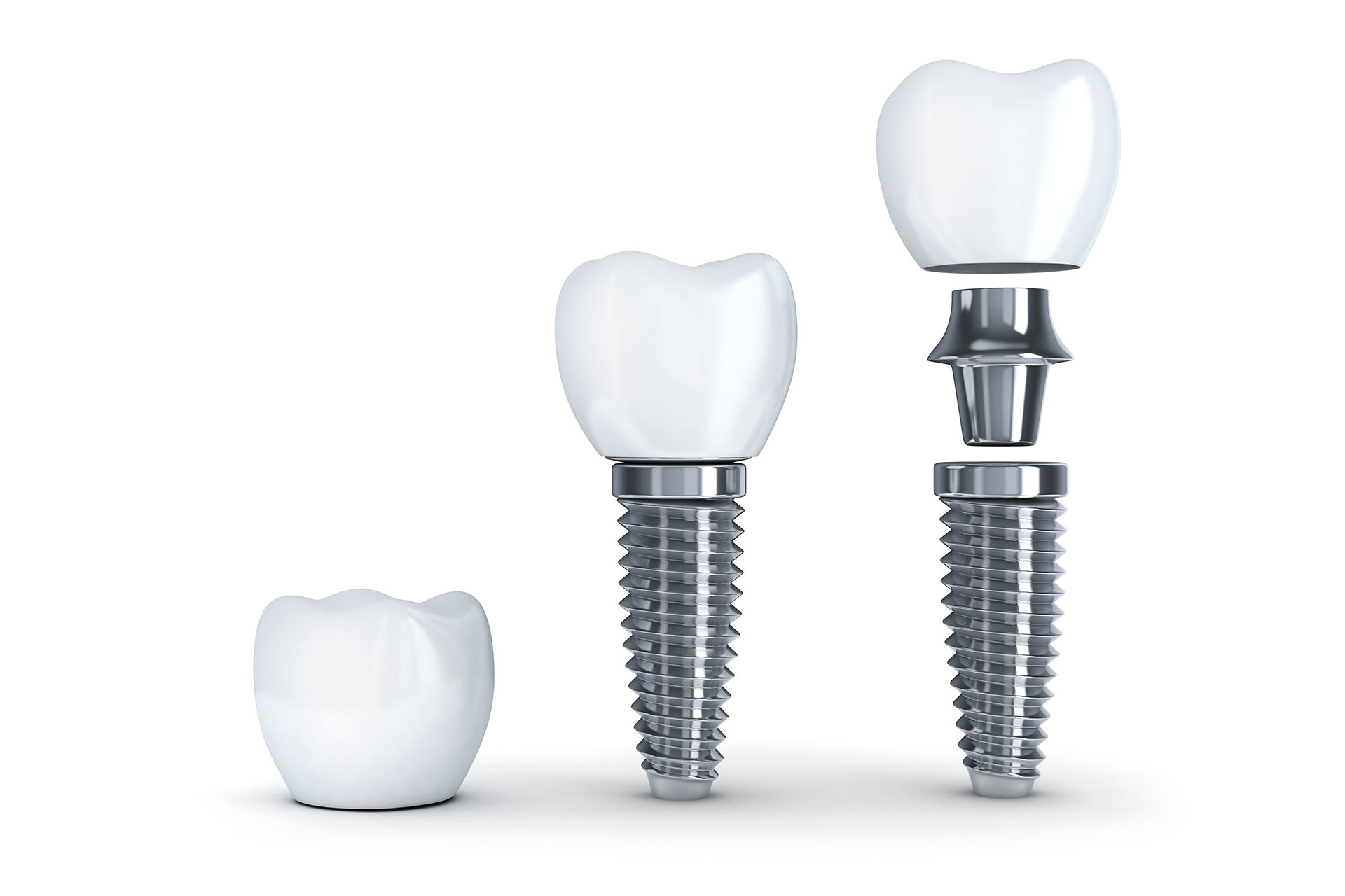 Structure of dental implants 